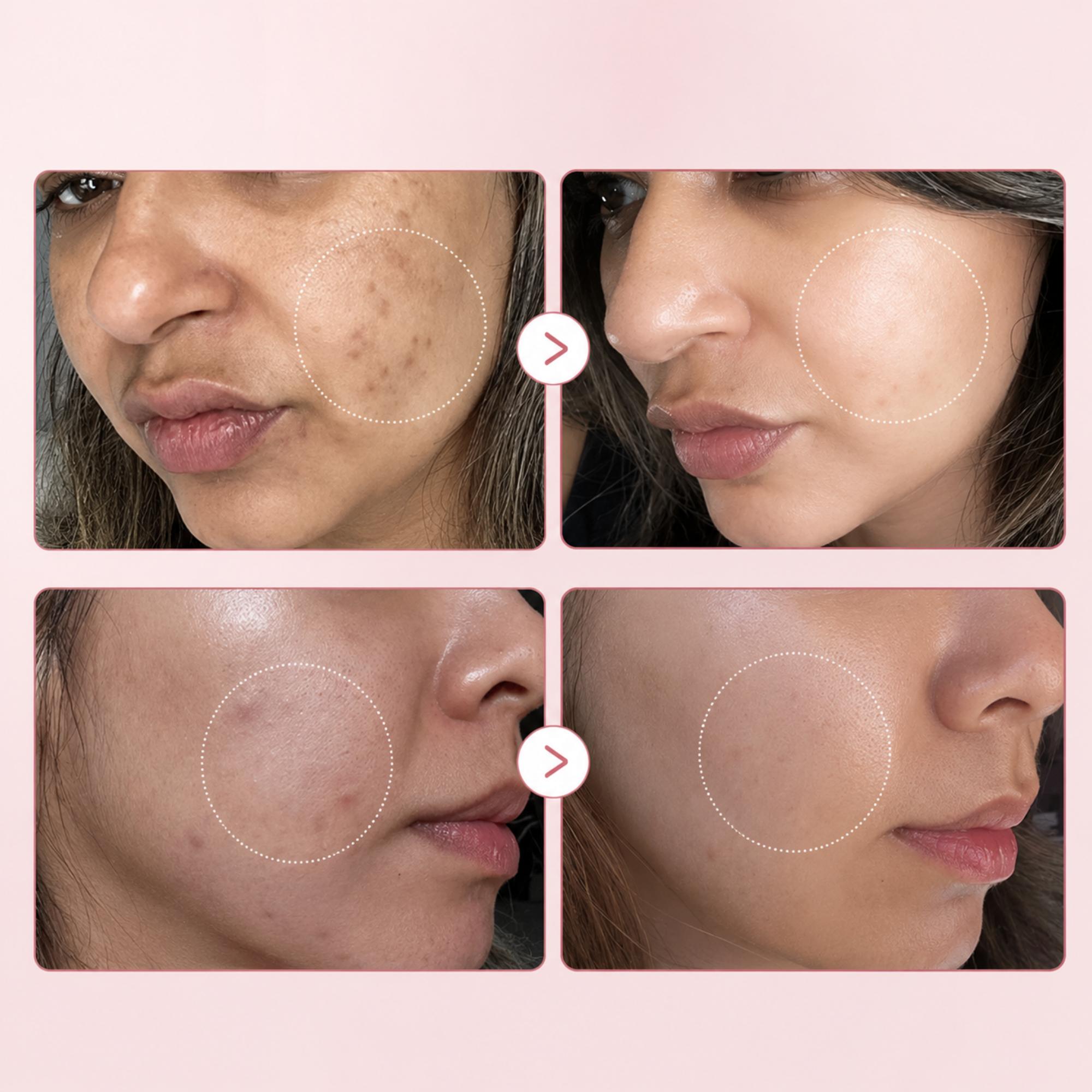 Korean Salmon PDRN Collagen Acne Repair Serum